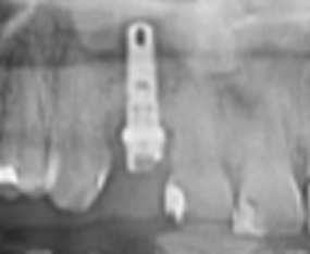 extraction de la dent  pose d'implant et de la couronne