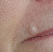 Carcinome lèvre supérieure