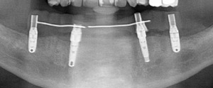 Dans la même séance : extraction de toutes les dents; pose de 4 implants et mise en charge immédiate