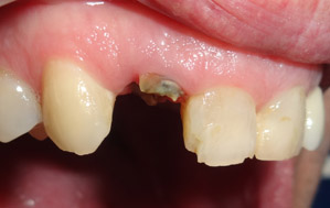 Dent non conservable aspect clinique