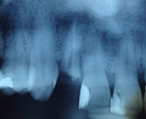 Dent non conservable aspect radiologique