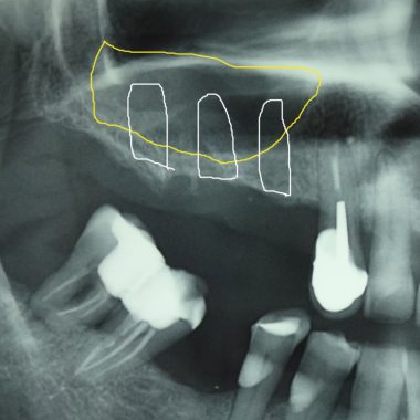 Manque de hauteur osseuse pour fixer les implants