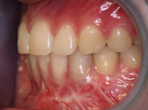 résultat après la chirurgie d'avancée de la mandibule