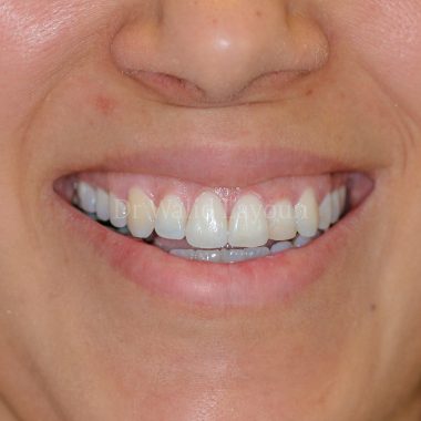 reduction de la hauteur du maxillaire pour la correction du sourire