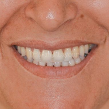 Amélioration du sourire par un allongement de la hauteur du maxillaire